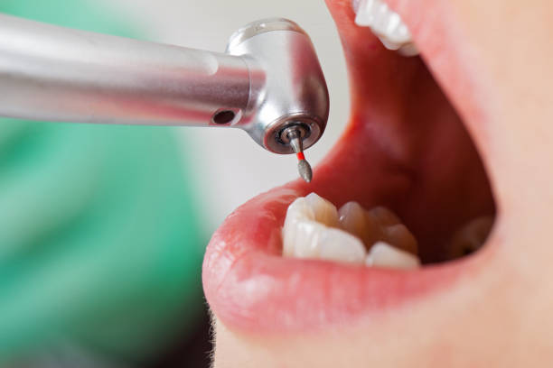 Best Emergency Dentist for Lost Fillings or Crowns in Edgewater, CO